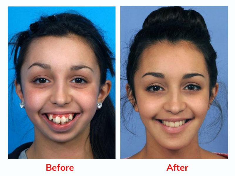 corrective jaw surgery